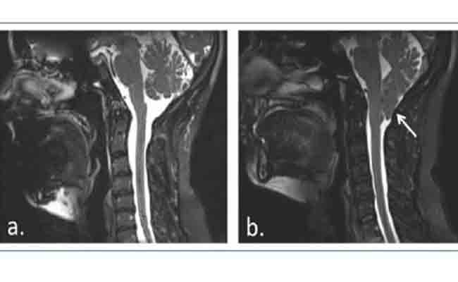 Chiari Malformation Type I: A Clinical Case