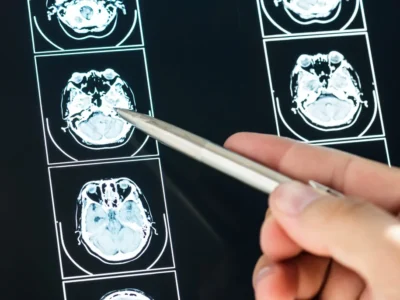Stroke or CVA: what it is, types, and possible sequelae. Brain after suffering a cerebrovascular accident (CVA).