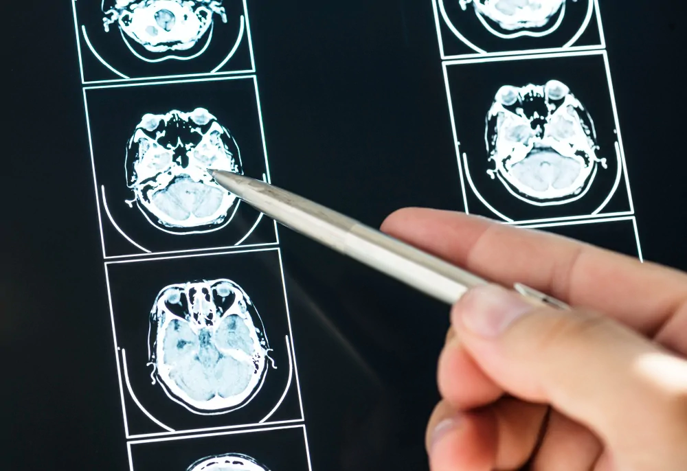 Stroke or CVA: what it is, types, and possible sequelae. Brain after suffering a cerebrovascular accident (CVA).