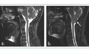 Clinical case of Chiari malformation type I