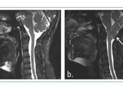 Clinical case of Chiari Type I malformation