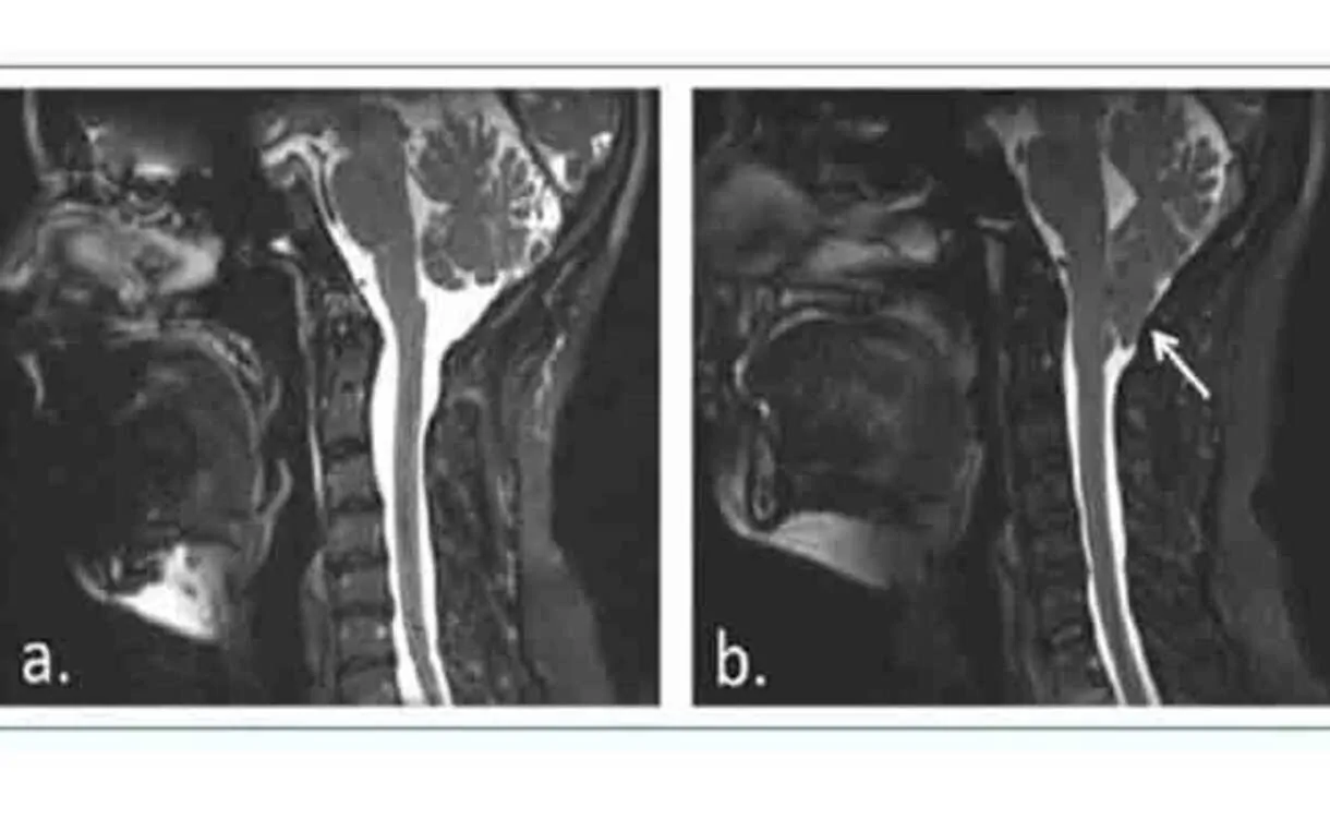 Clinical case of Chiari malformation type I