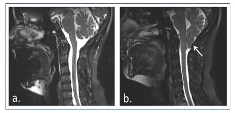 Clinical case of Type I Chiari Malformation