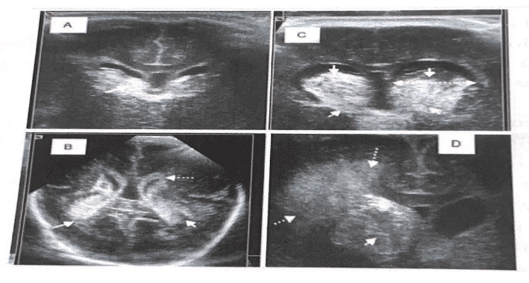 Figure 1.1. IVPH Grade I (4), II (B), III (C), IV (D, with associated parenchymal infarction). Source: Llorens-Salador R, Moreno-Flores, A. The ABC of transfontanelar ultrasound and more. Radiology (2016) 129-141, 58.