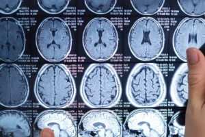 Uncommon Causes of Stroke