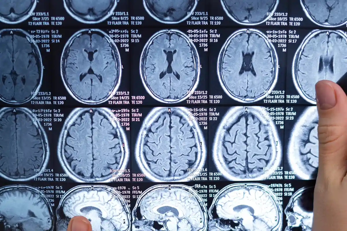 Uncommon Causes of Stroke