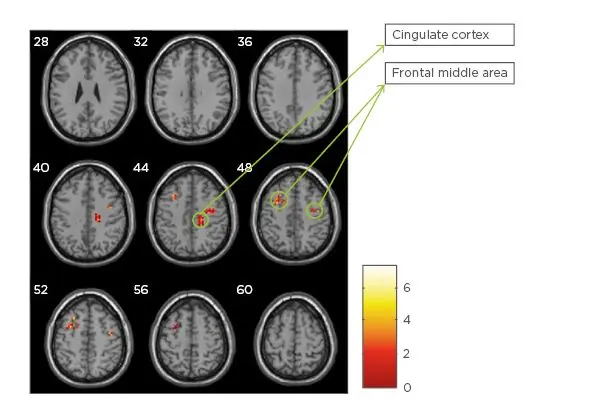 Neuropsychological changes and gray matter volume in patients with multiple sclerosis