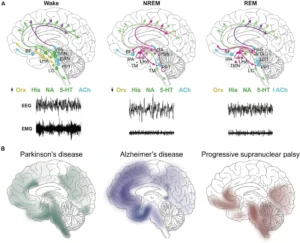 Neural networks involved in sleep-wake cycle regulation and the distribution of pathology in different neurodegenerative diseases.